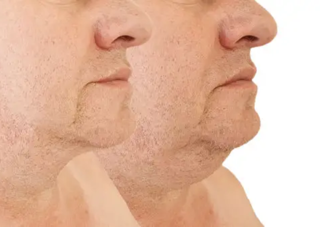 Aqualyx Double Chin Treatment
