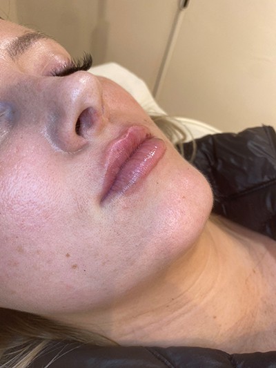 Lip Enhancement - After