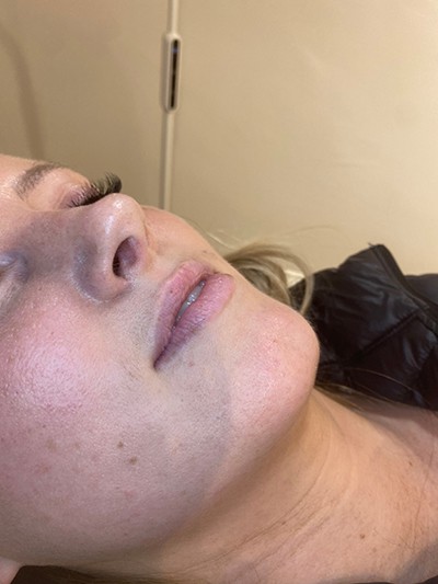 Lip Enhancement - Before
