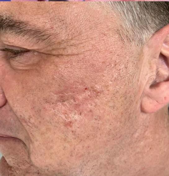 Microneedling - After