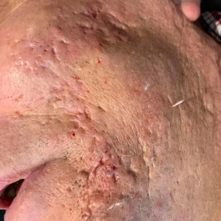 Microneedling - Before