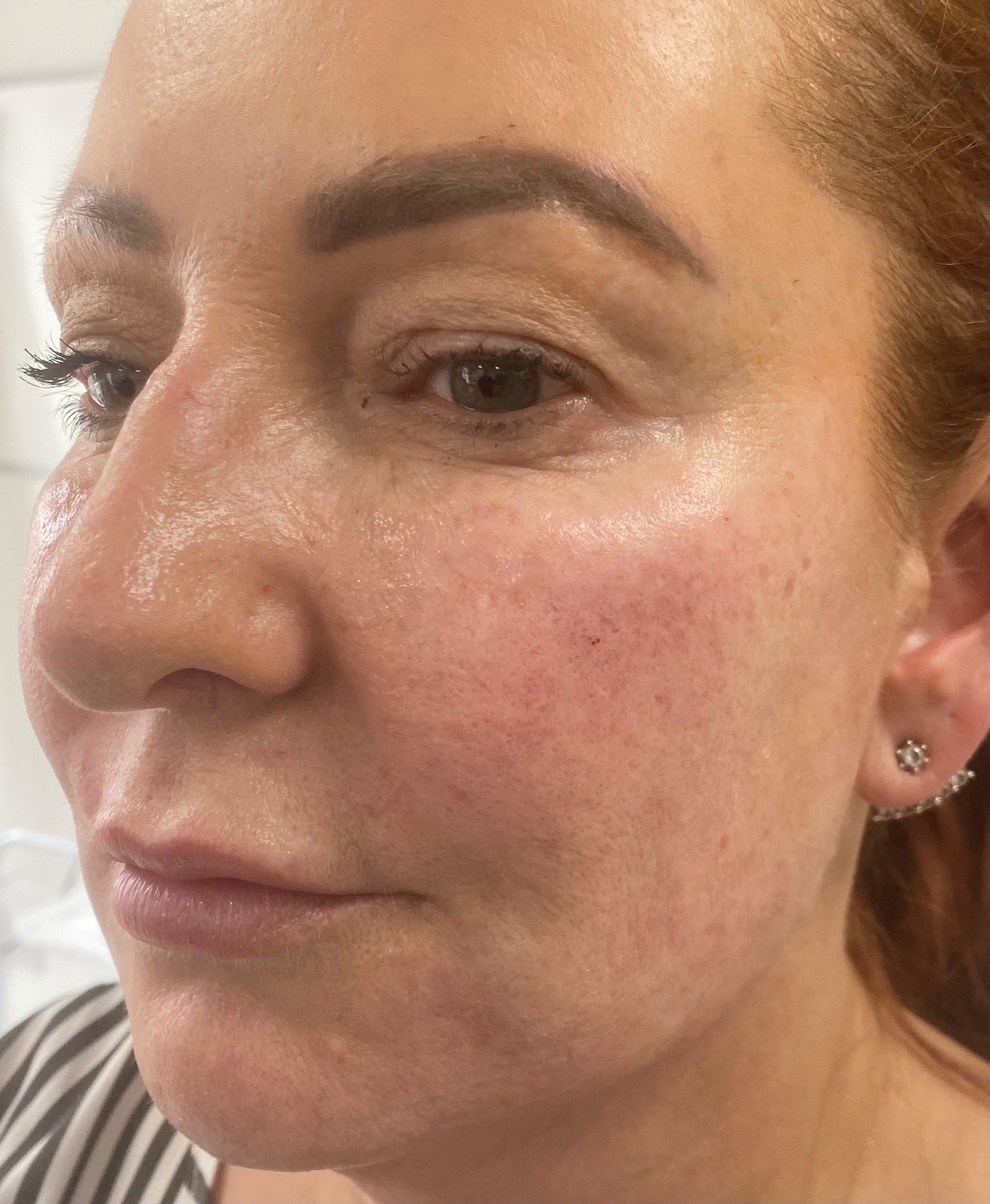 Dermal Fillers - After