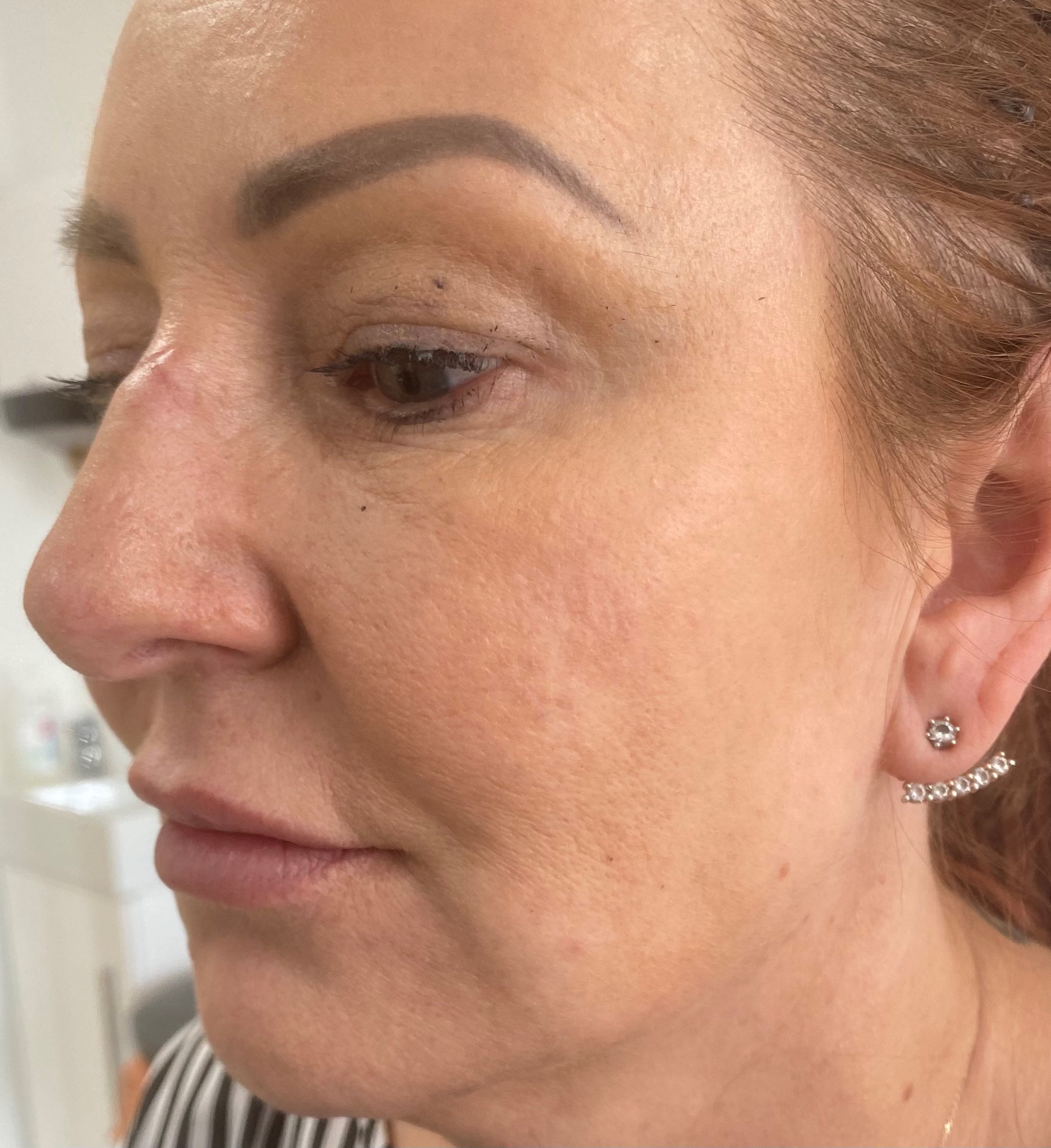 Dermal Fillers - Before