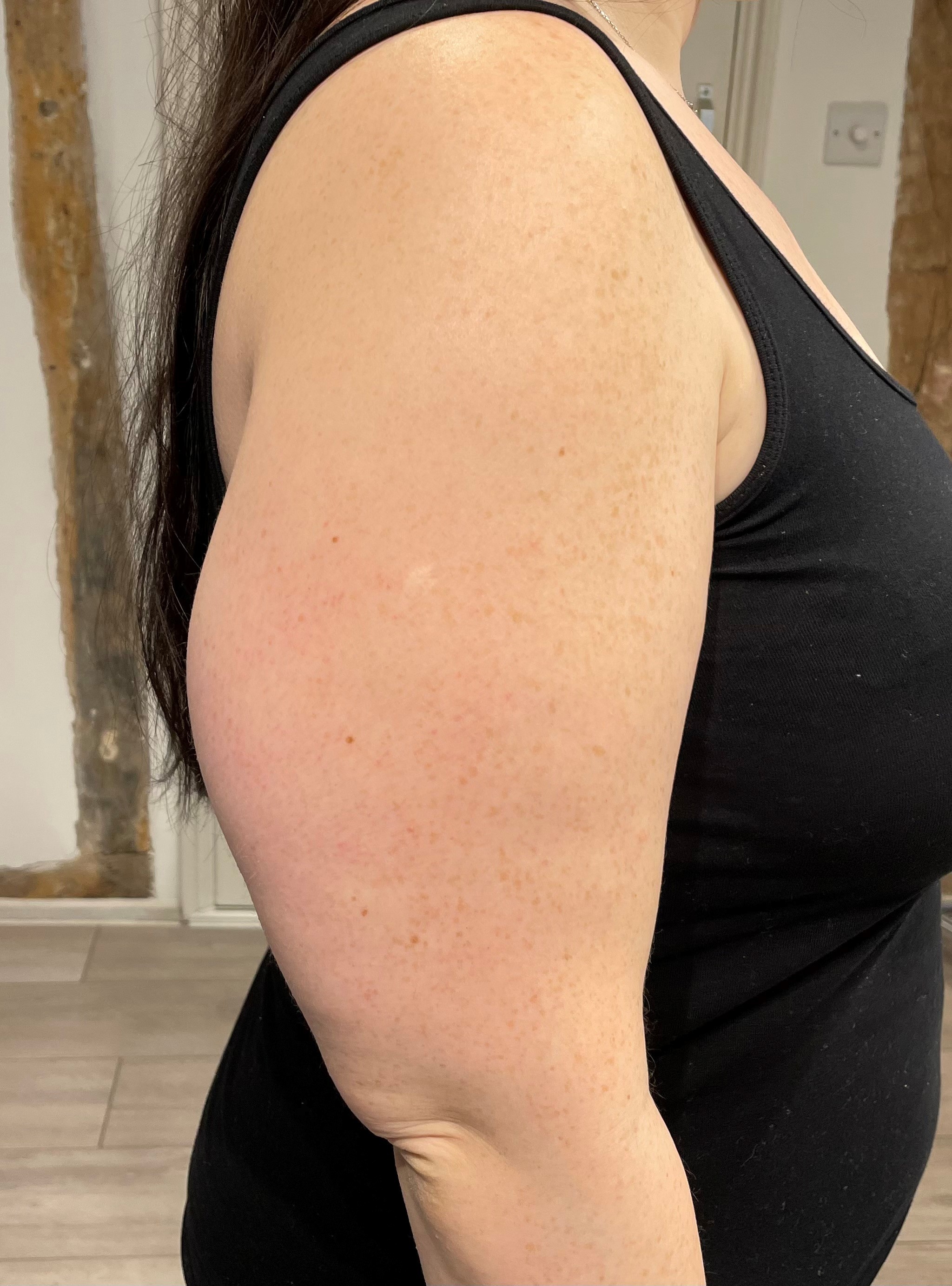 Aqualyx Double Chin Treatment - Before