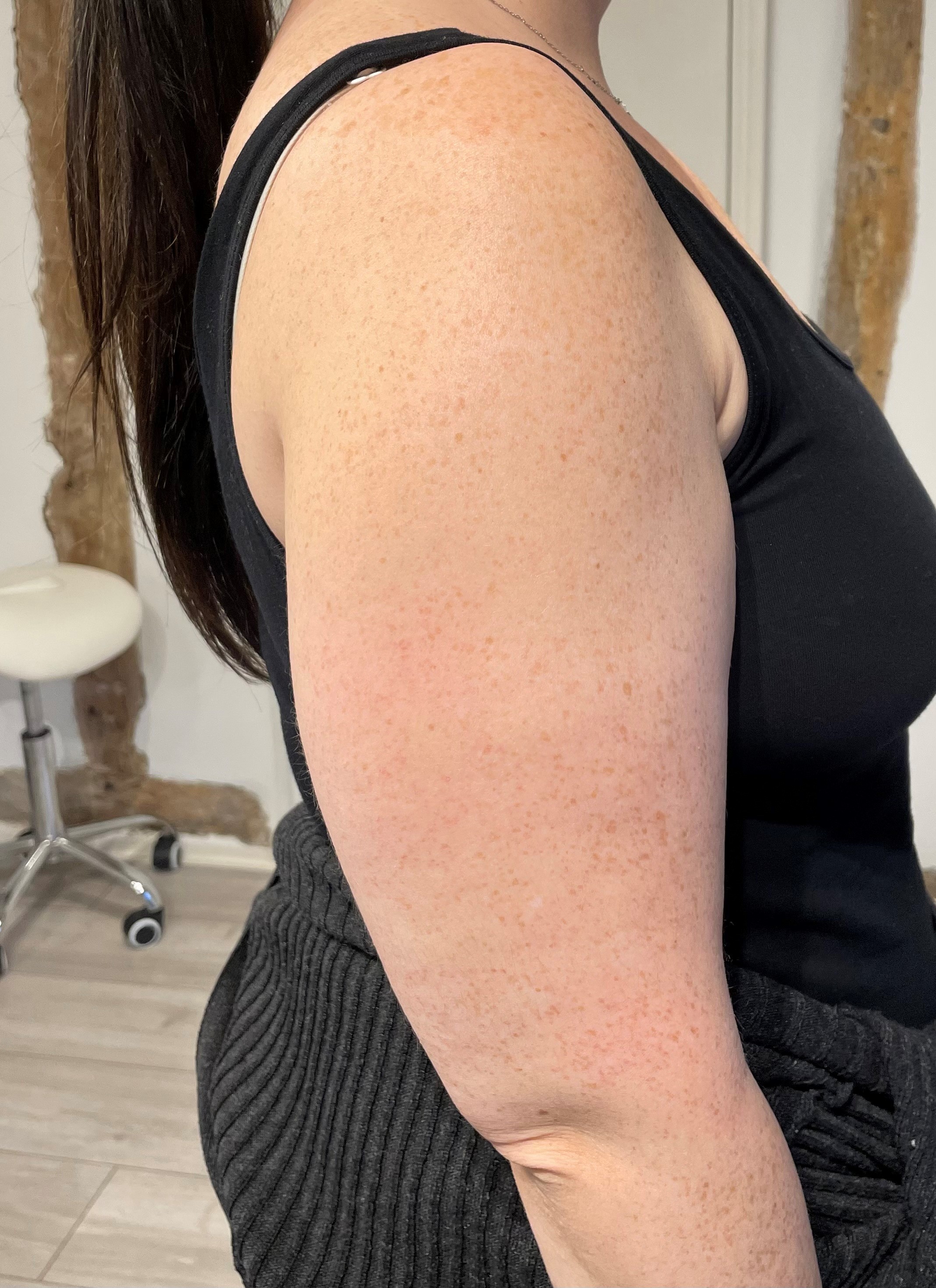 Aqualyx Double Chin Treatment - After