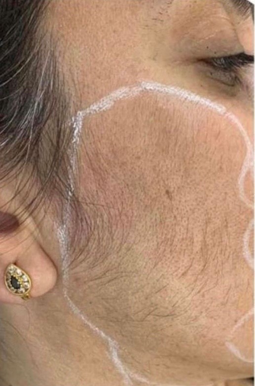 LumiLASE™ Laser Hair Removal - Before