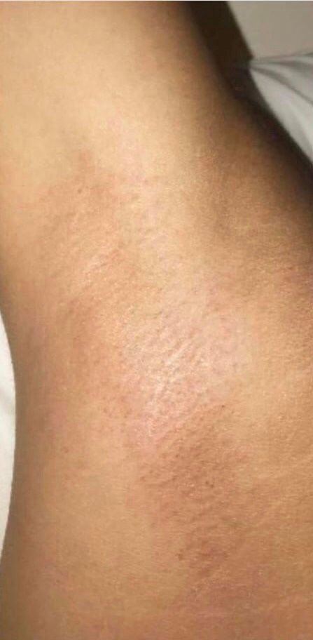 LumiLASE™ Laser Hair Removal - After