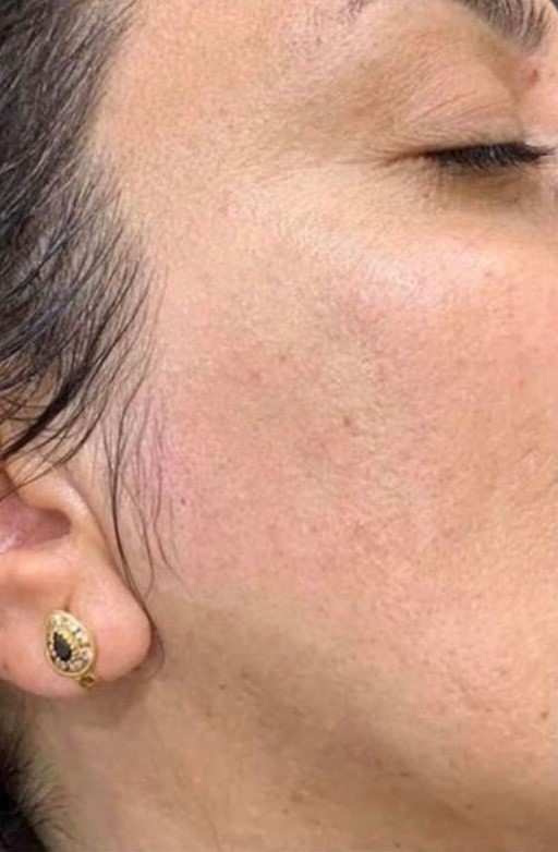 LumiLASE™ Laser Hair Removal - After