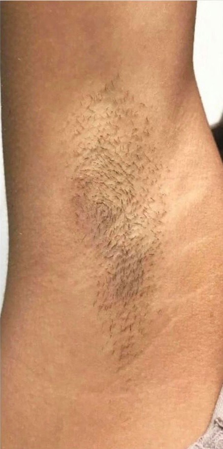 LumiLASE™ Laser Hair Removal - Before